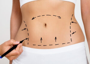 Abdominoplastie Tunisie