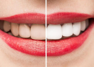 Facettes dentaires Tunisie