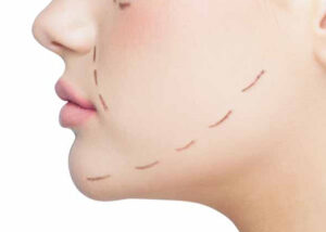 Génioplastie Tunisie