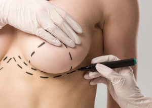 Lifting seins Tunisie