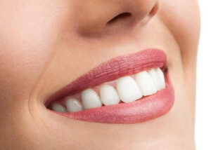 blanchiment dentaire