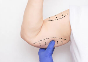 lifting des bras Tunisie